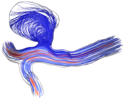 Vortex-flow within cerebral aneurysm
