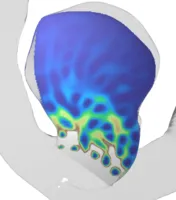 Velocity field / blood perfusion of aneurysm with porous medium model.